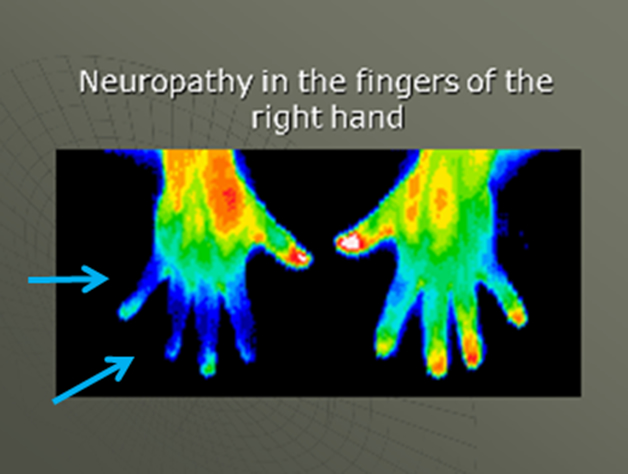 Neuropathy vs Joint Pain in Hands
