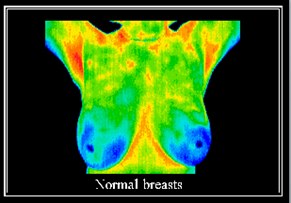 Normal Breast Thermogram